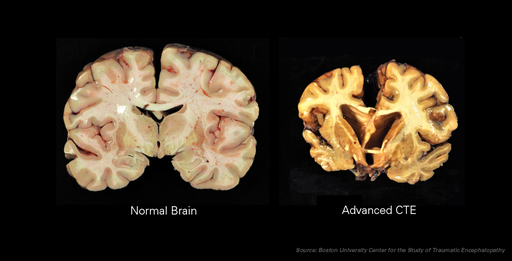 Advanced CTE in the brain